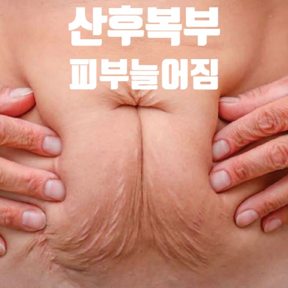  산후복부의 피부변화와 관리 (3) 복부 늘어짐(Abdominal laxity) - 배가 쭈글쭈글해요!