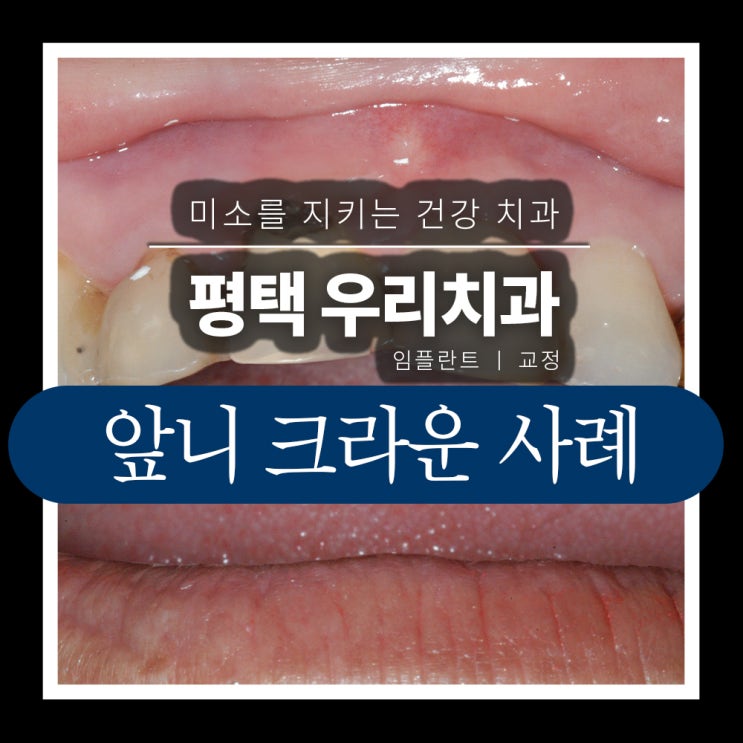 평택 앞니 충치 레진 크라운 치과 치료 구강검진 올바른 사례