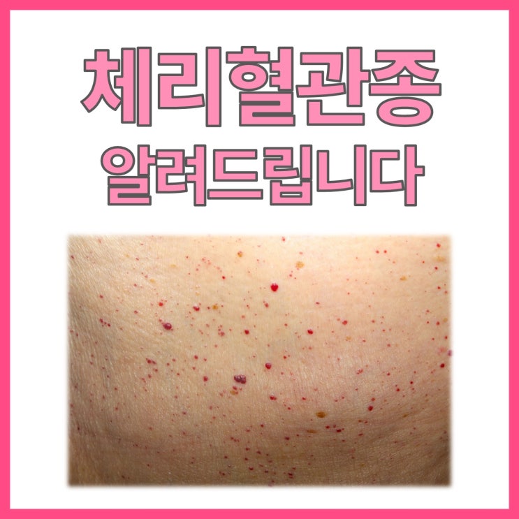  피부의 붉은 점? 체리혈관종 (cherry angioma)에 대해