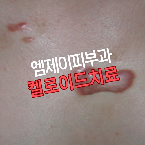 [대전 켈로이드] 켈로이드 치료는 엠제이피부과