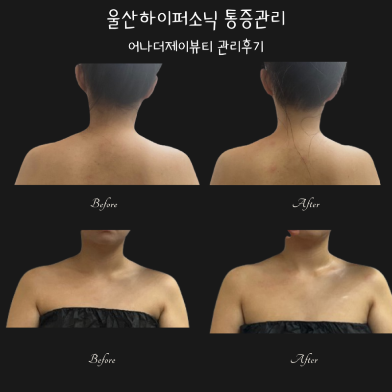 울산하이퍼소닉 슬리밍케어 예신추천 어나더제이뷰티