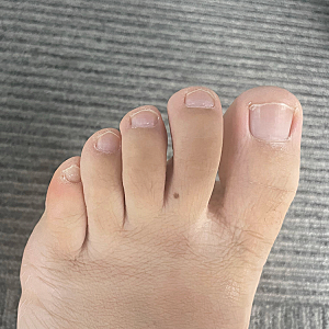 큐로힐 토네일 발톱 무좀 빠르게 퇴치하기