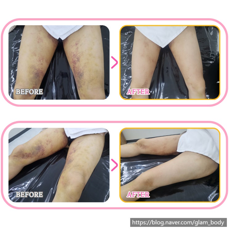  하체지방흡입후관리 붓기와 통증으로 힘들다면?
