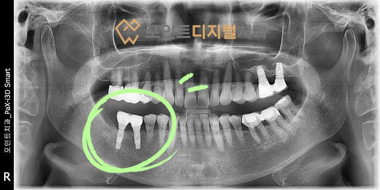  [탕정치과] 20년된 임플란트 보철물 재제작(3i 임플란트) / 천안 아산