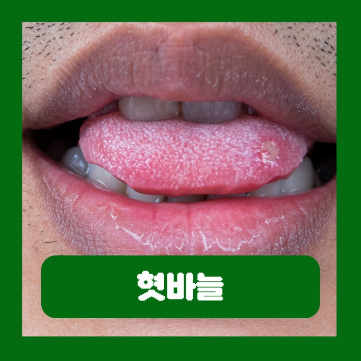  혓바늘빨리없애는법 났을때 증상 통증 오래 지속 구내염 제거 치료