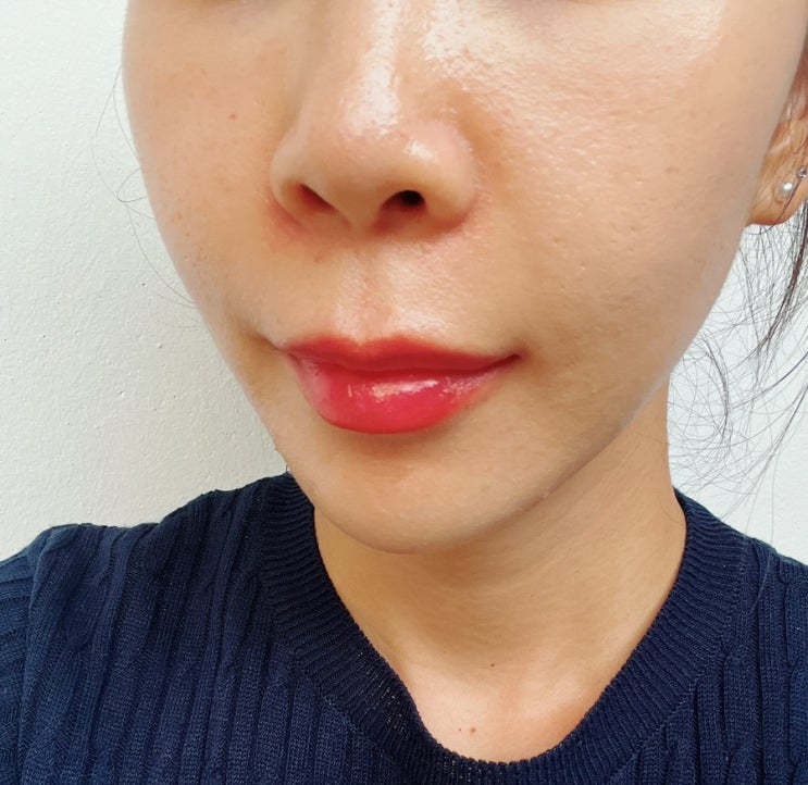  얼굴 스킨보톡스 후 효과 시기, 부작용 정보 공유 후기