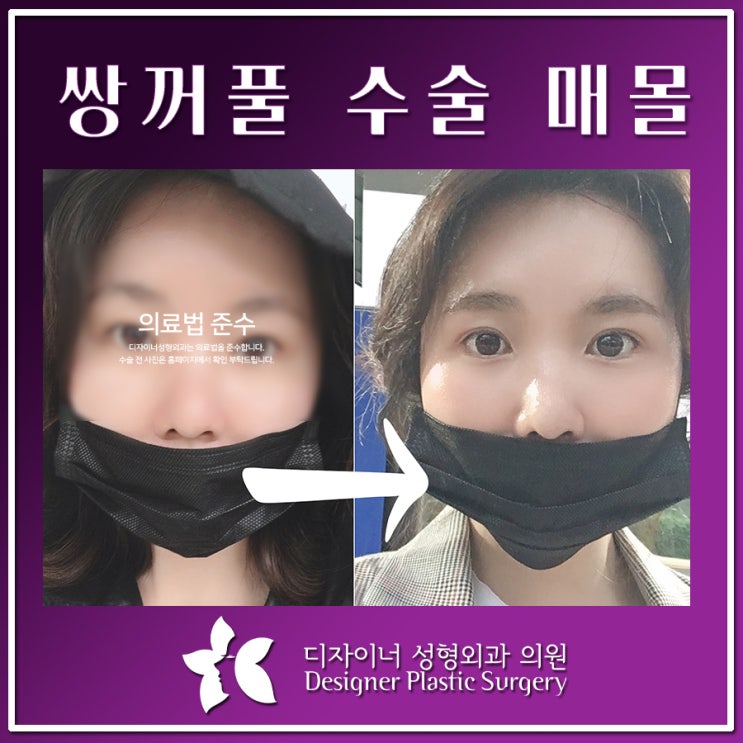  쌍꺼풀 수술 매몰 세미아웃 후기 및 비용