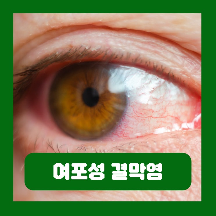  여포성 결막염 증상 원인 마스카라 눈화장 지우고 자야하는 이유