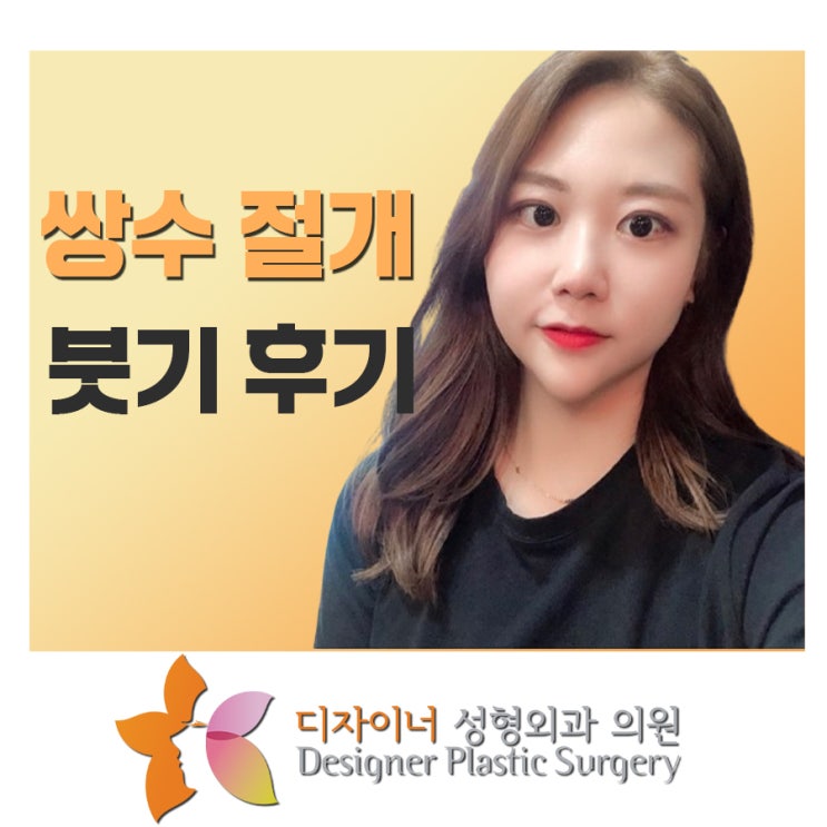  쌍수 절개 붓기 후기로 확인하는 한달째 사진