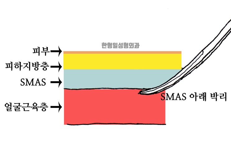 안면거상잘하는곳 안면거상 수술 방법