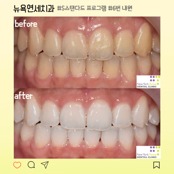  강남역치아미백 맞춤형 시술로 누런이 하얗게