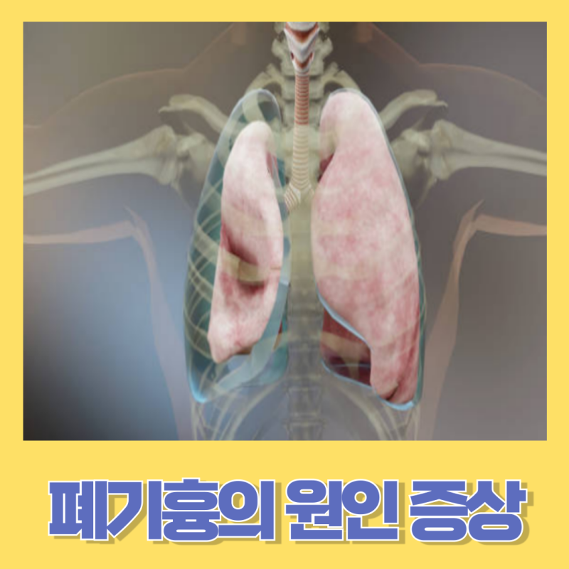 폐기흉의 정의 원인과 증상 폐기흉의 치료법