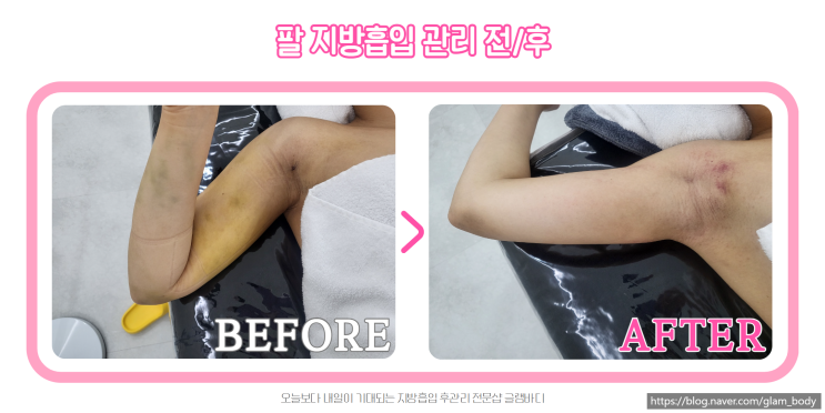  팔 지방흡입 실밥제거 시기와 후관리방법은?