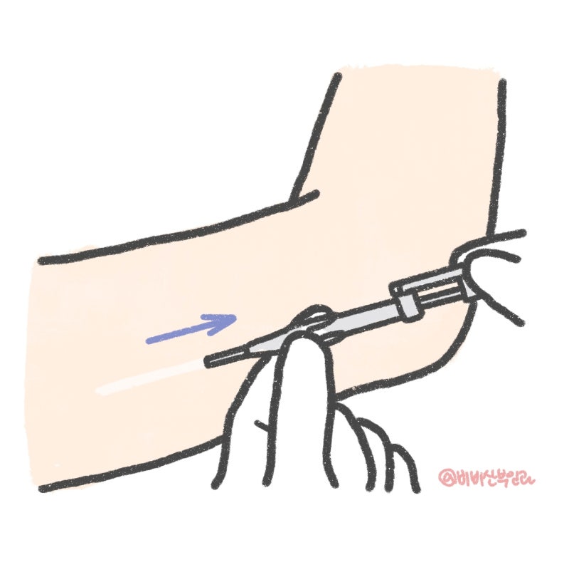 슬기로운 피임 생활 - 임플라논, 영통동산부인과