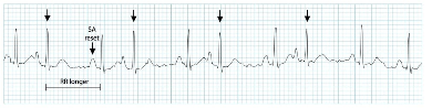 심방조기수축 : 의학용어 APC, PAC / atrial premature contraction EKG 리듬 / 심방조기박동 ...