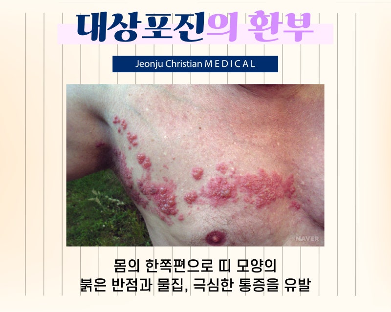 전주 대상포진 치료병원, 기독병원