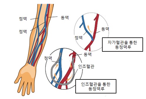  동정맥루 조성술 후 관리