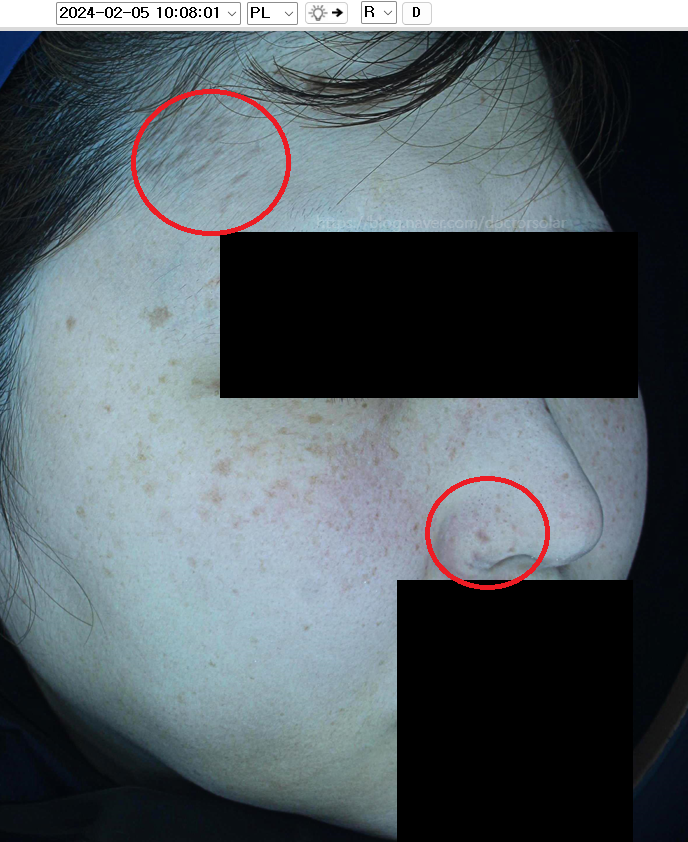 ABNOM(애브넘)후천성양측성오타모반, 평생 기미인 줄 알고 살았더니 치료가 가능하다? : 네이버 블로그