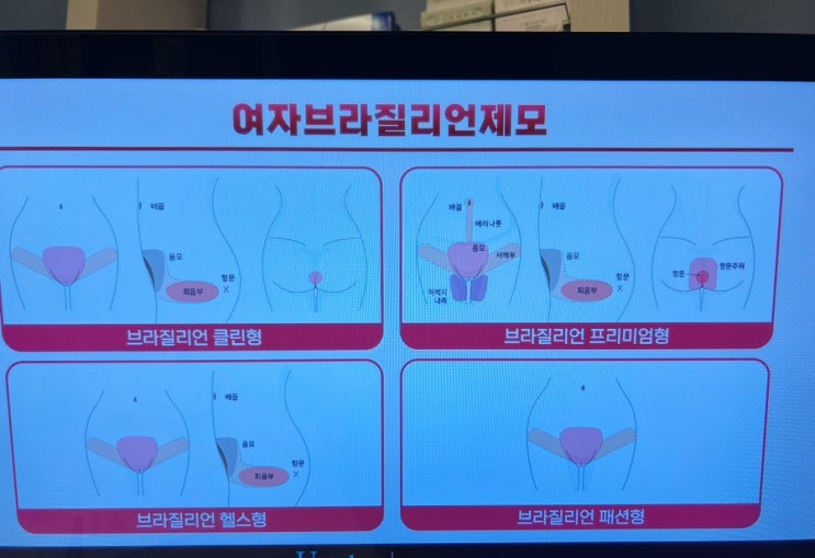  강남 브라질리언 레이저 제모기계 레이저제모 후기