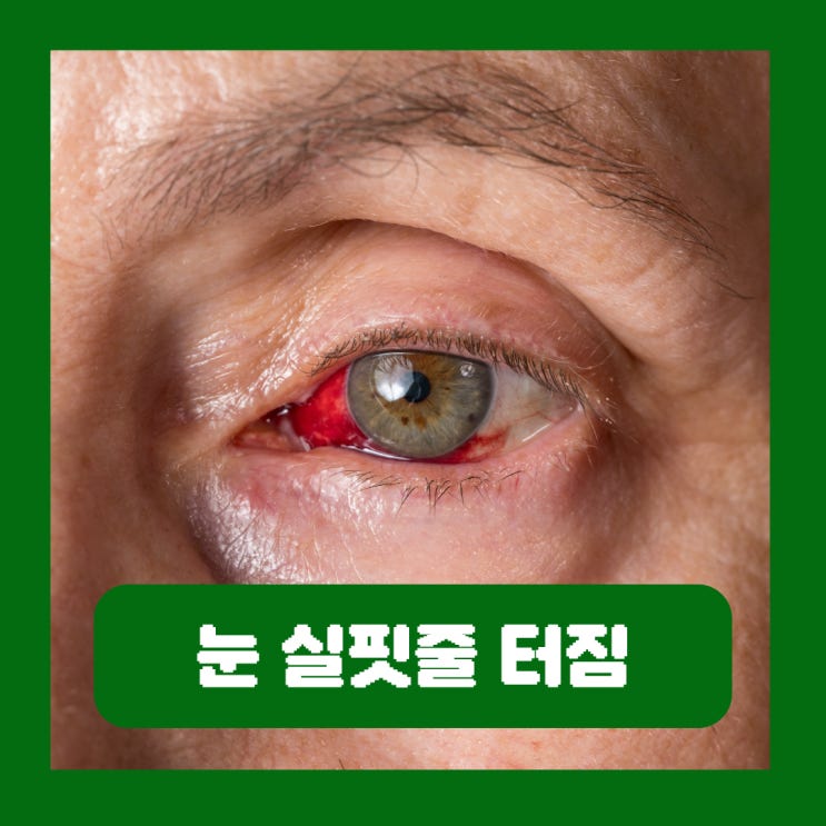  눈 실핏줄 터짐 원인 치료 안약 결막하출혈 각막 신생혈관 병원