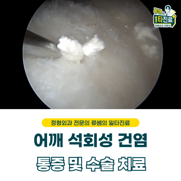  어깨 석회성 건염 통증에 따른 수술 치료  (의사작성)