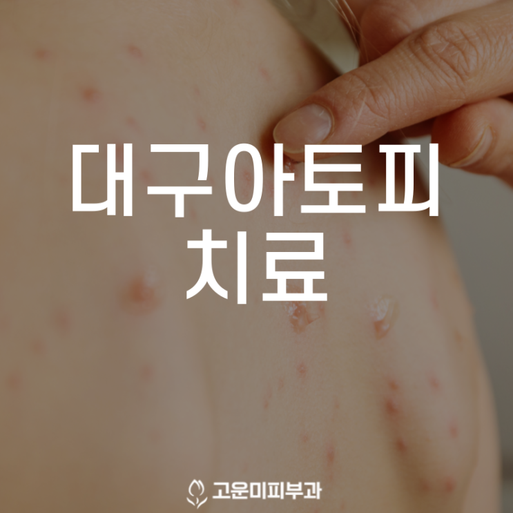 대구아토피치료 상태를 정확히 파악해 치료하고 철저한 예방과 관리가 중요합니다