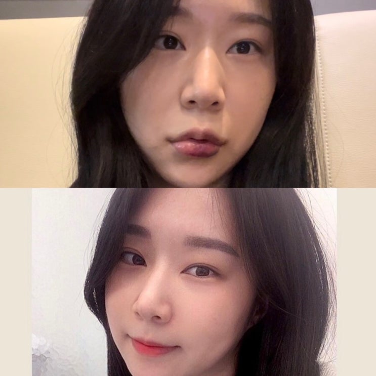  구월동피부과 입술필러 2cc 후기(통증 및 약 일주일차 멍, 붓기 상세 후기)