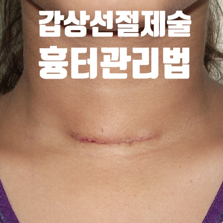  갑상선수술 후 관리법 (흉터의 예방과 치료)