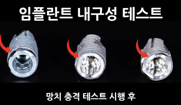  삼전동임플란트치과 자주묻는질문 <총정리> - 1편