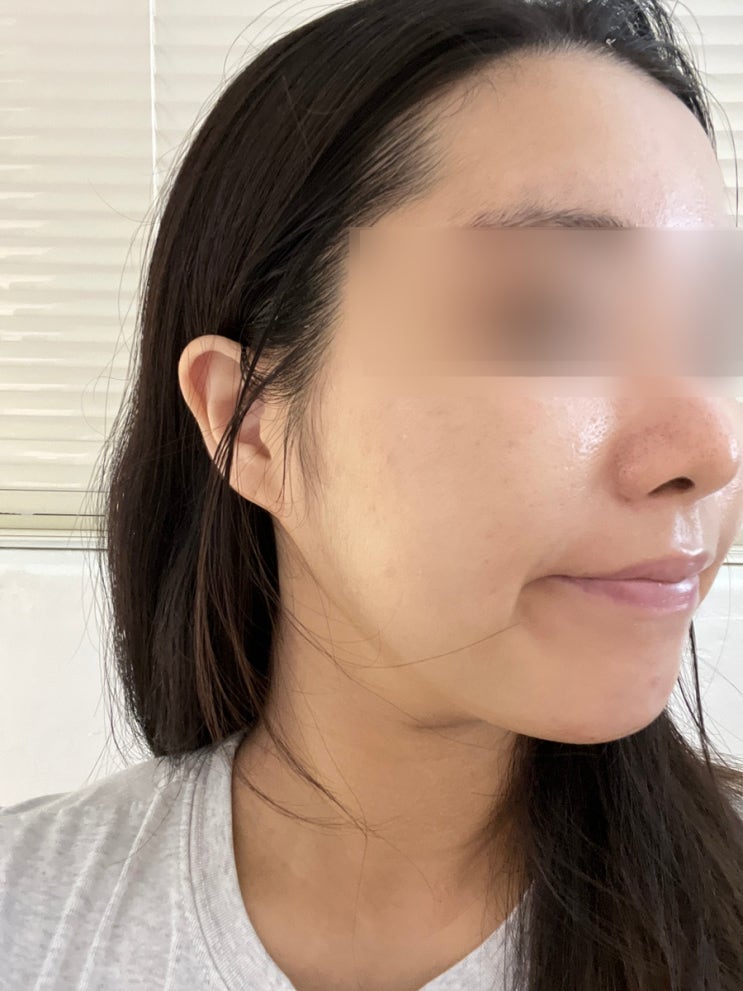  고양 일산 피부관리 세멘시트 관리는 이곳 에그뮤즈 스킨스칼프 일산점