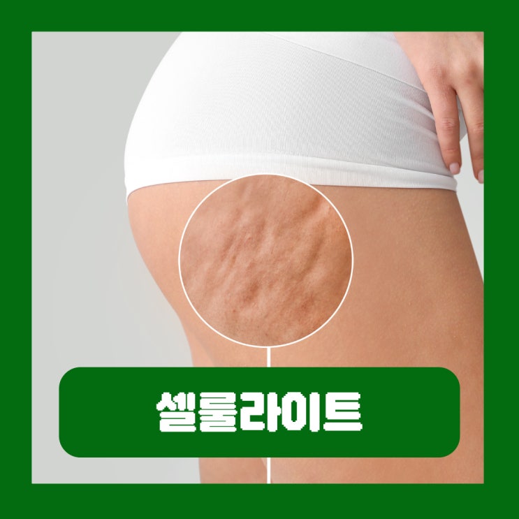  허벅지 셀룰라이트 제거 없애는법 생기는 이유 원인