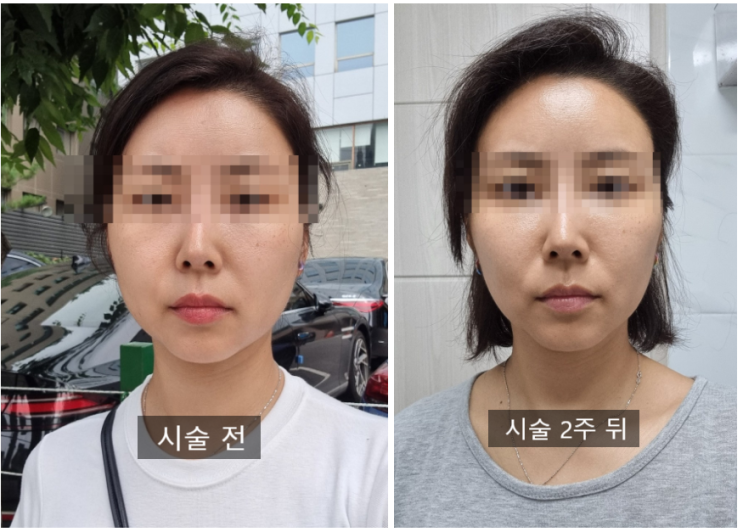 언주역 국산 뉴럭스 사각보톡스 찐 후기 언주역 국산 뉴럭스 사각보톡스 찐 후기