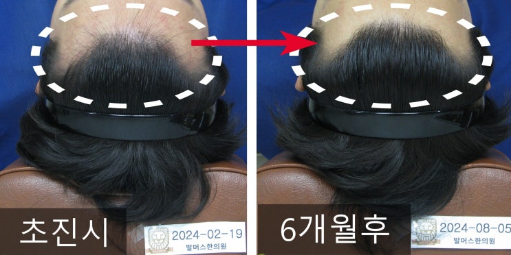  마포탈모, 20대 남성의 지루성 피부와 앞머리 탈모 치료사례