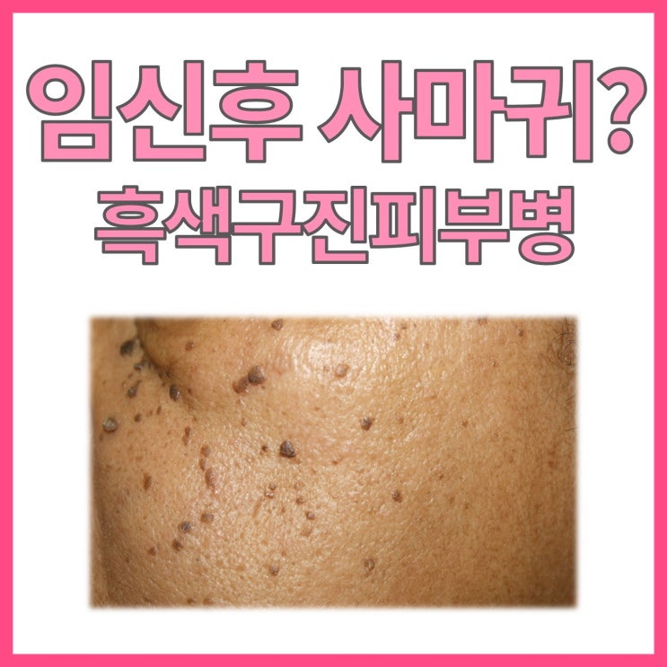  임신 후 사마귀? 흑색 구진 피부병 (Dermatosis papulosa nigra)에 대하여