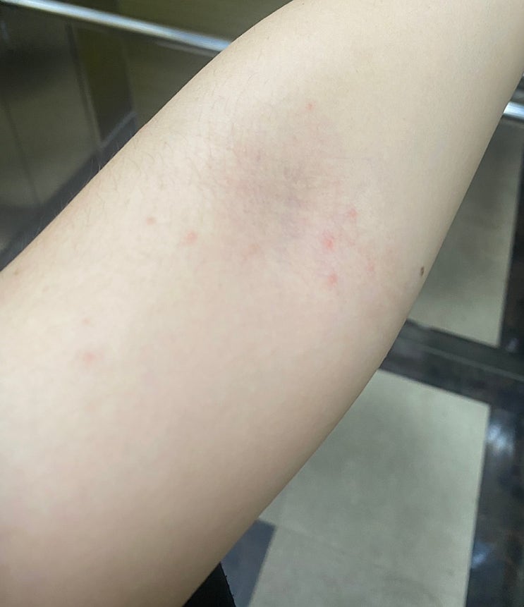  팔 땀띠 접촉성피부염 치료기 1탄