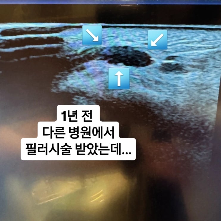  안산필러 뭉침 결절 부작용 해결 방법은?