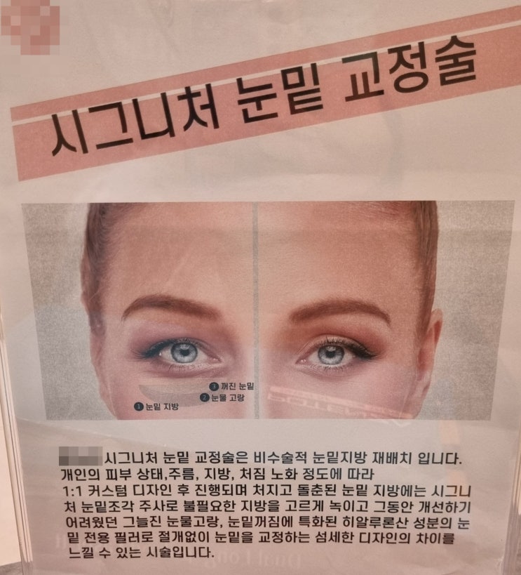 구리역 피부과 눈밑 교정필러 효과 후기 구리역 피부과 눈밑 교정필러 효과 후기