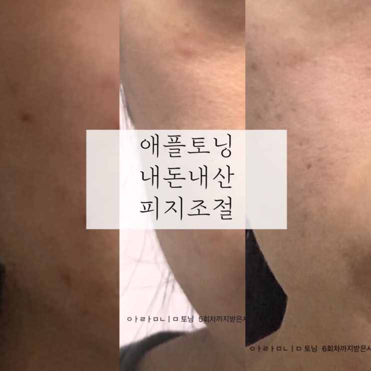 내돈내산 | 애플토닝 후기 (피지조절 토닝) 가격, 통증, 다운타임, 효과