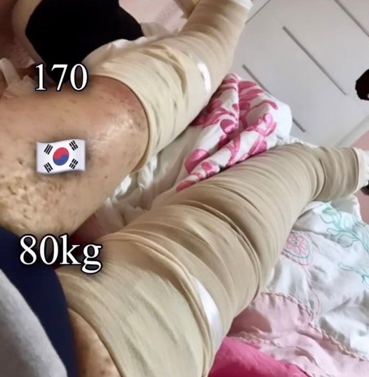  최준희 병 루프스 어쩌다 골반괴사까지