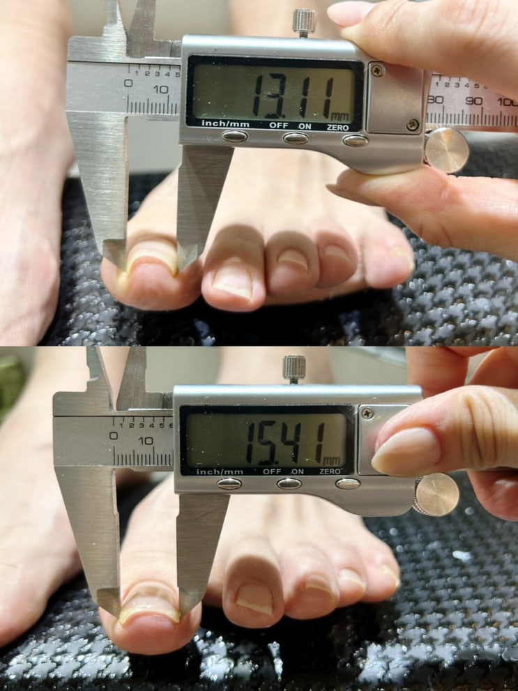  내성발톱교정 잘하는 하찌네일 문제성 발톱 관리 전문가