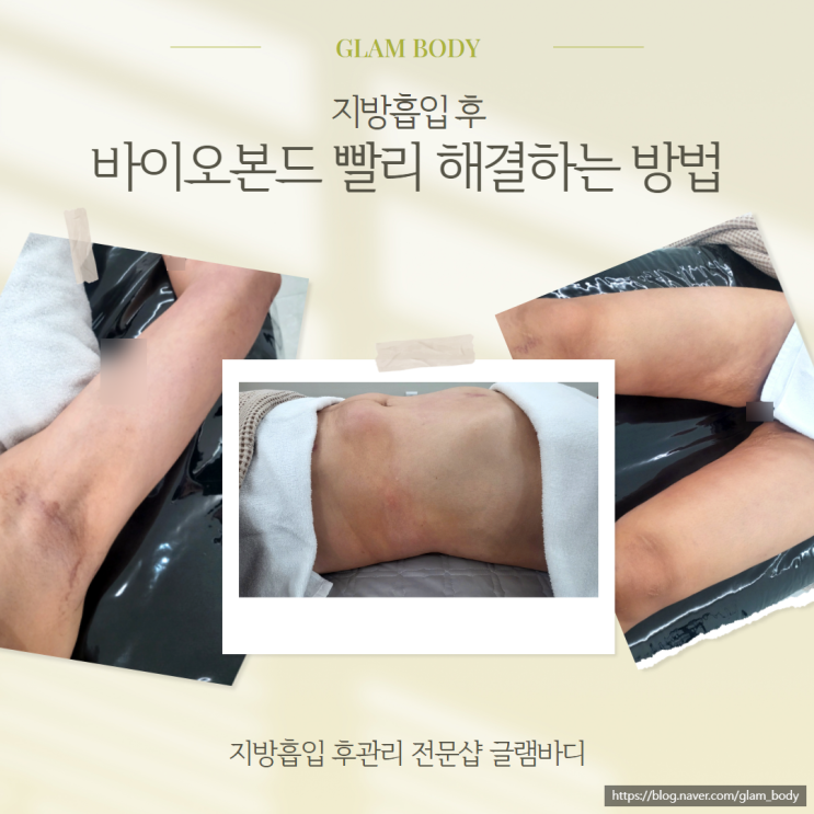  지방흡입 바이오본드 빨리 해결하는 방법!