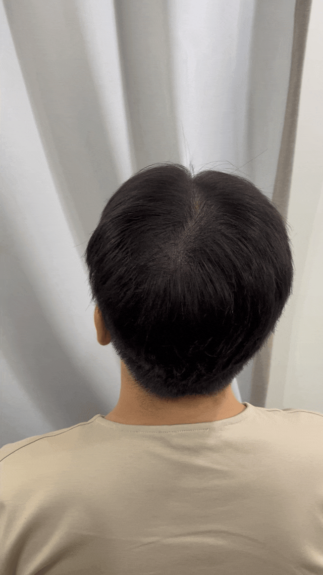  평택smp 남자머리숱 커버 시술 후기입니다~