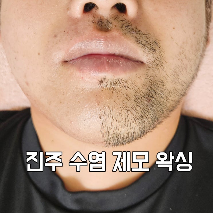  진주 수염 제모 왁싱, 진주 수염 레이저 시술, 진주브라질리언왁싱, 고성왁싱샵, 진주경상대왁싱, 삼천포왁싱샵, 사천왁싱샵, 진주 남자 수염 레이저 제모