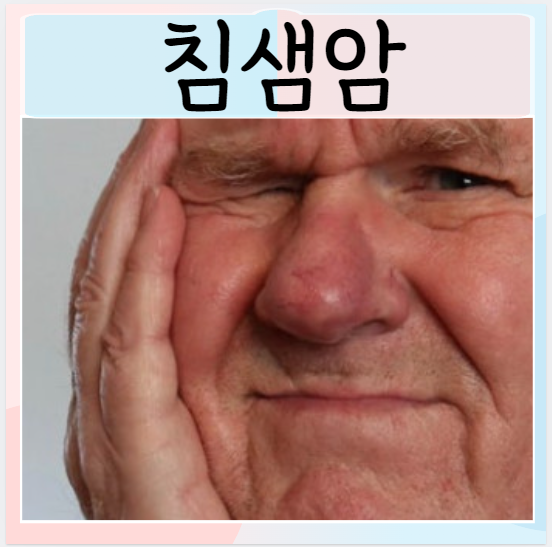  침샘암 원인 증상 귀밑샘 치료 예방법