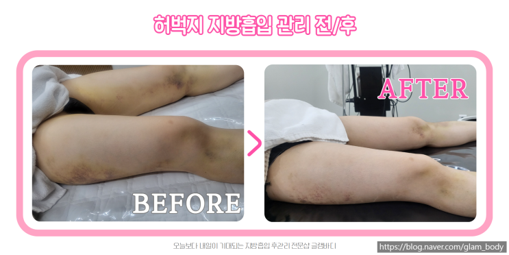  허벅지 지방흡입 고주파관리로 멍 빠르게 빼는 방법은?