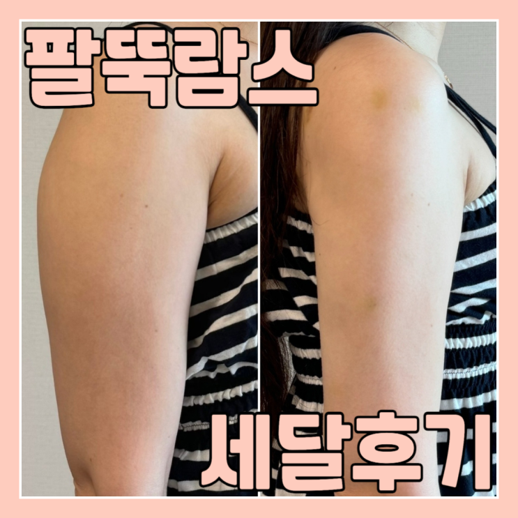  팔뚝무한람스 세달차 황금기 효과 후기(후관리, 가격, 많이 받은 질문들)