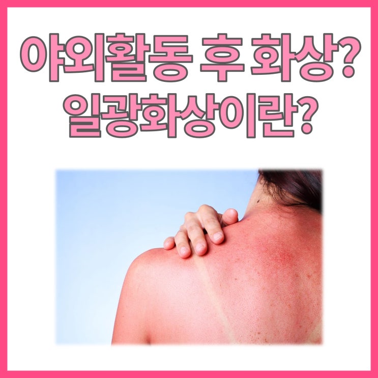  밖에만 있었을 뿐인데, 피부가 붉어졌다? 일광화상에 대하여