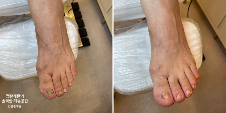  레푸스 원주점 :: 너무나도 만족했던 효도 관리 문제성 발톱 및 각질 관리