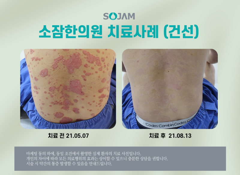 안면건선 한방치료 및 관리방법을 살펴봅니다.