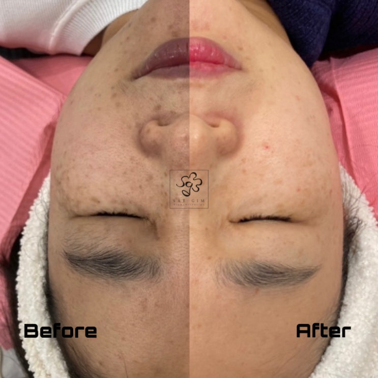  까맣게 탄 피부 하얗게 되돌리는 방법